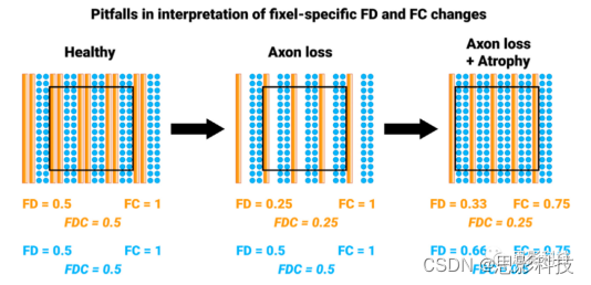 基于扩散磁共振成像的FBA（Fixel-Based Analysis）分析