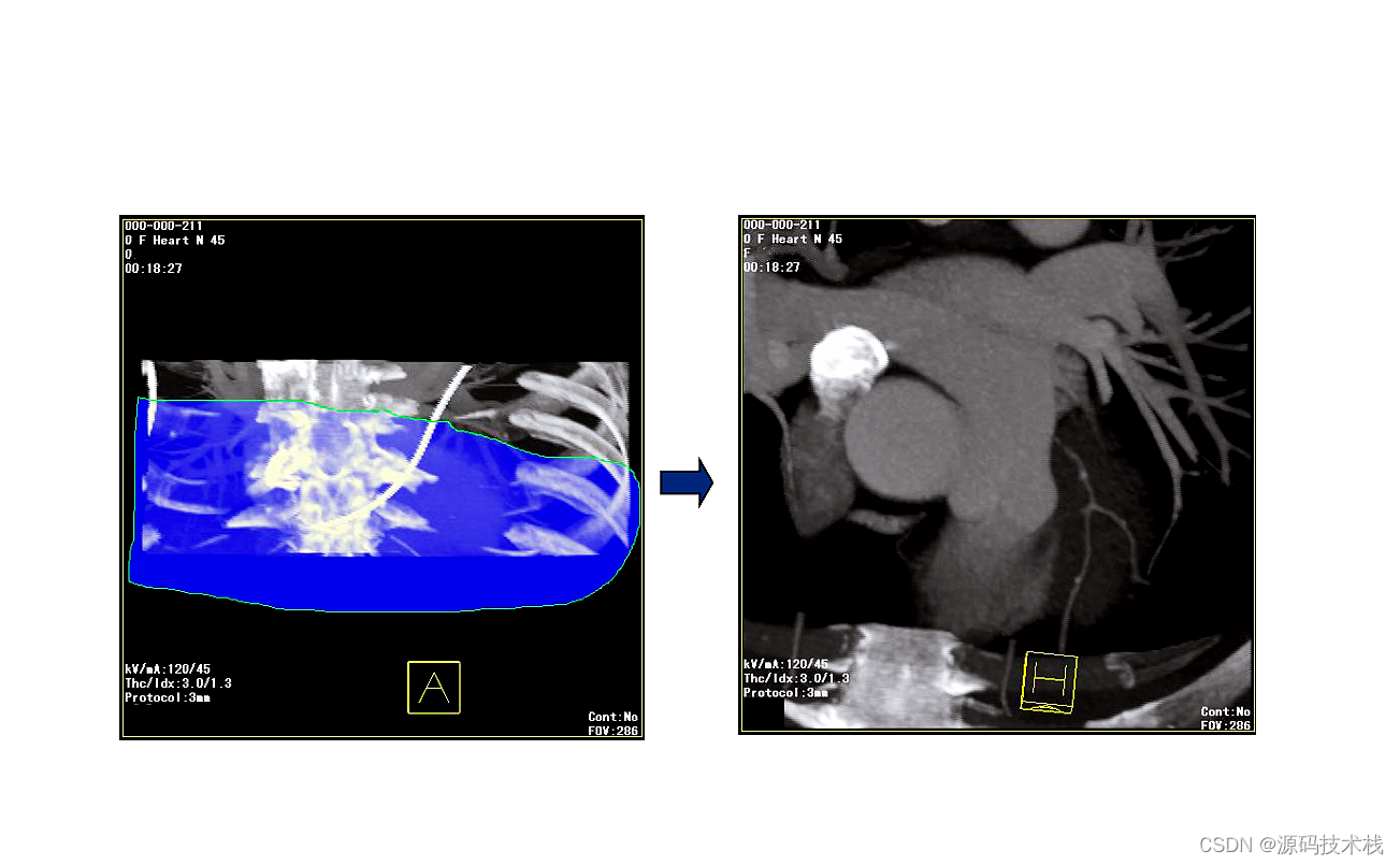 医学影像系统源码（MRI、CT三维重建）