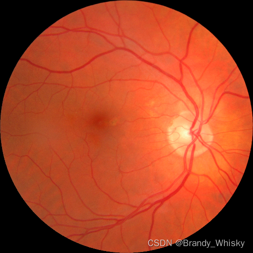 糖尿病视网膜病变检测 (diabetic retinopathy detection)