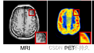 [医学图像知识]CT图和PET图的成像表现形式