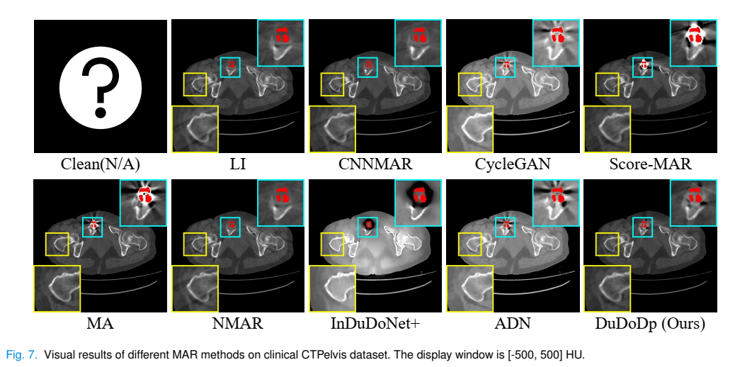 Unsupervised CT Metal Artifact Reduction by Plugging Diffusion Priors in Dual Domains