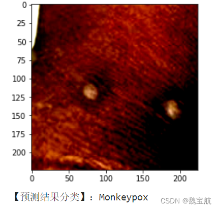 基于ResNet101实现猴痘病毒识别任务