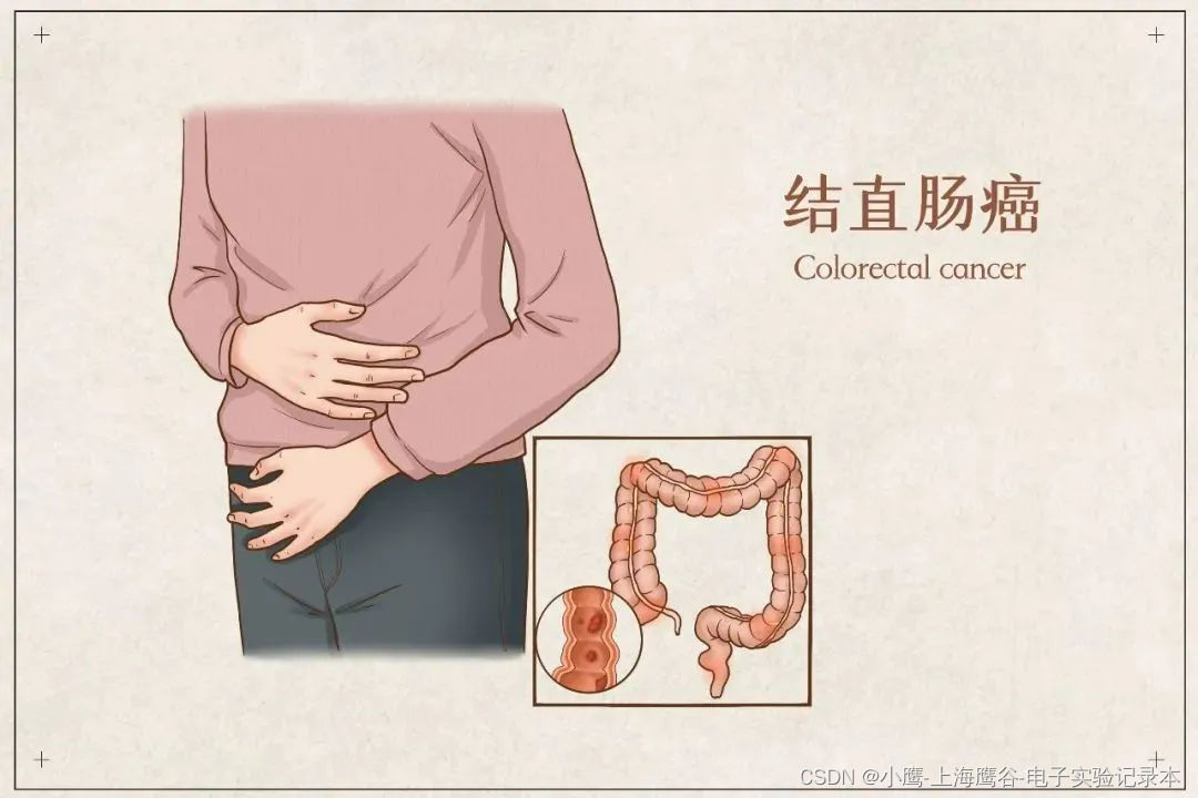 鹰谷靶点fda首次批准靶向gucy2c的i期临床实验结直肠癌cart治疗