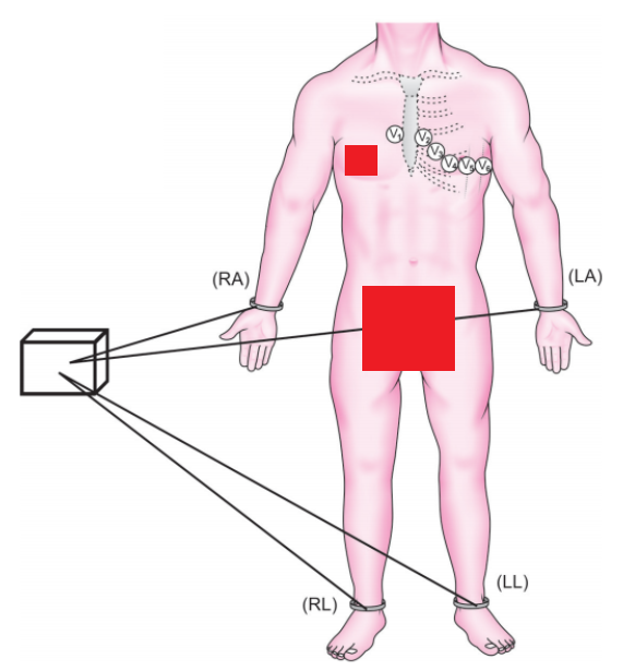 肢体导联位置图片图片