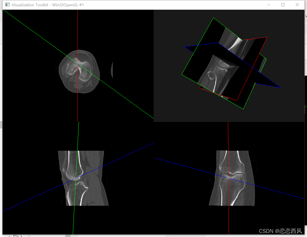 三维重建 PyQt Python MRP 四视图（横断面，冠状面，矢状面，3D）