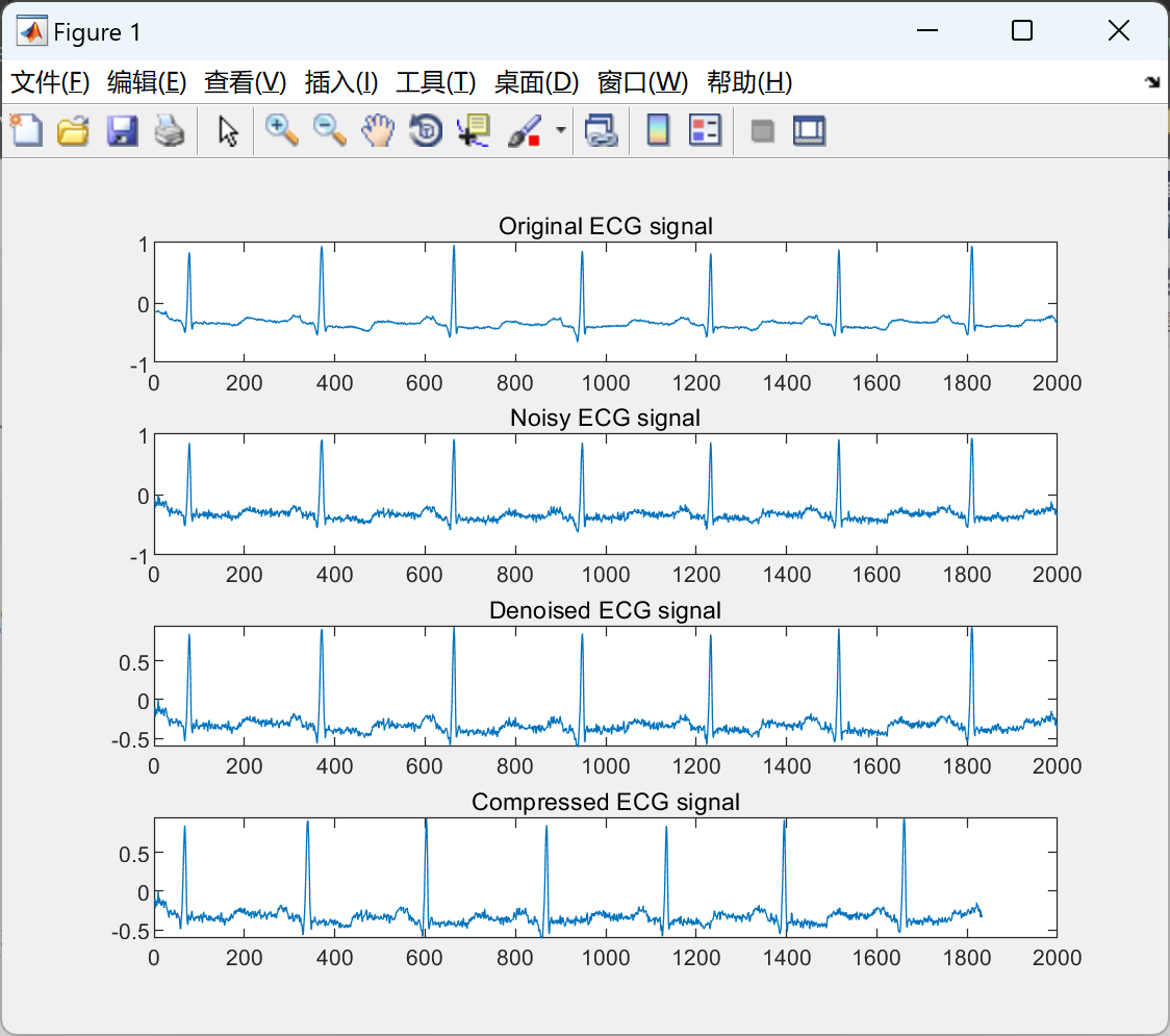 【心电图信号压缩】ECG信号压缩与通过三次样条近似重建的ECG信号压缩研究（Matlab代码实现）