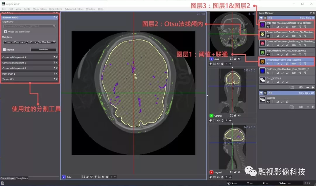 介绍一些免费/开源的医学影像后处理工具