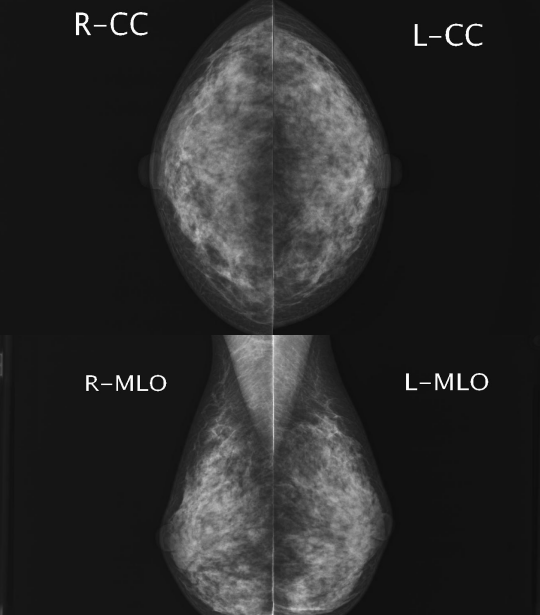 乳腺内外斜位图片