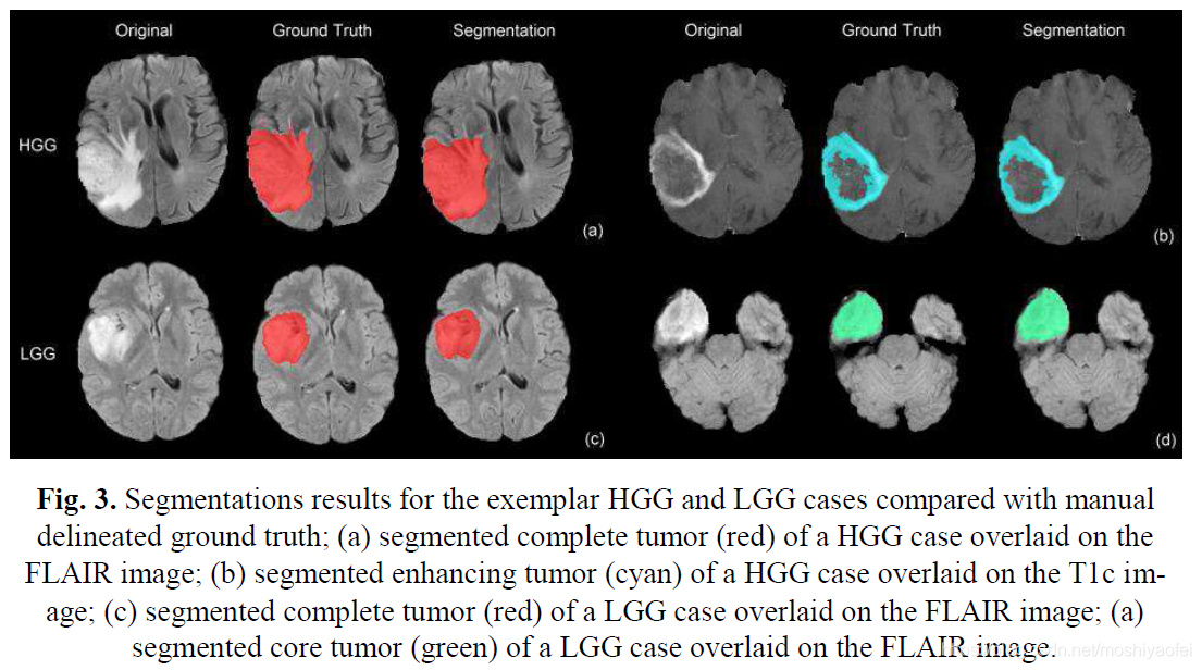 Automatic Brain Tumor Detection And Segmentation Using U Net Based Automatic brain tumor detection and segmentation using u net based