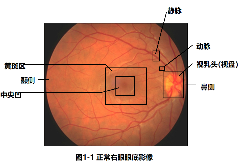 糖尿病性视网膜病变分级诊断
