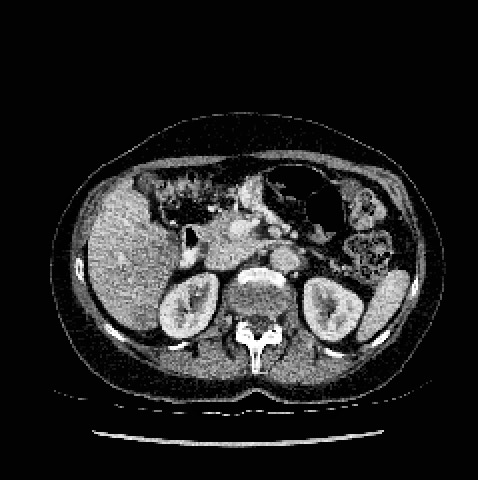 医学图像预处理(五) 器官与病灶的直方图