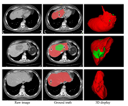 H Denseunet Hybrid Densely Connected Unet For Liver And Tumor Segmentation From Ct Volumes Artyourtimes的博客 Csdn博客