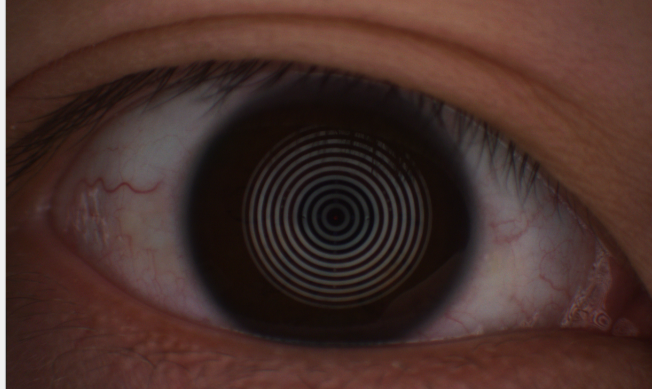 眼睛结构粗分离 - 巩膜 - 虹膜