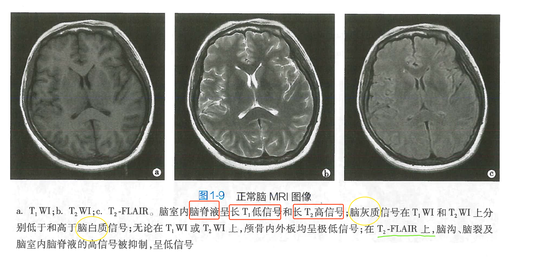 flair抑制自由水图片