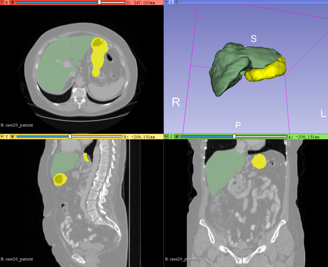 3D Slicer - 图像分割标注教程