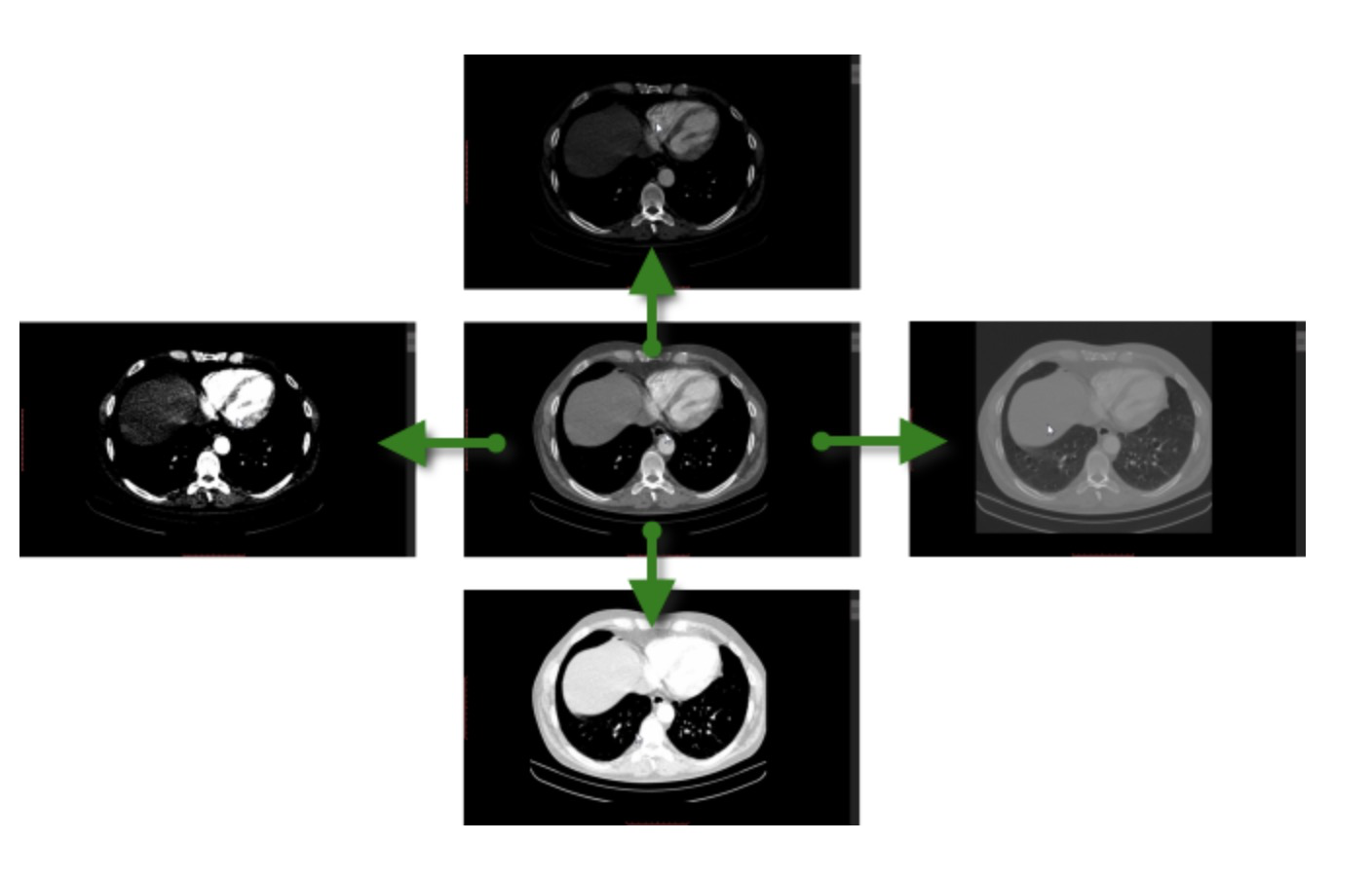 ct值到灰度值的映射以及windowing中的窗宽和窗位