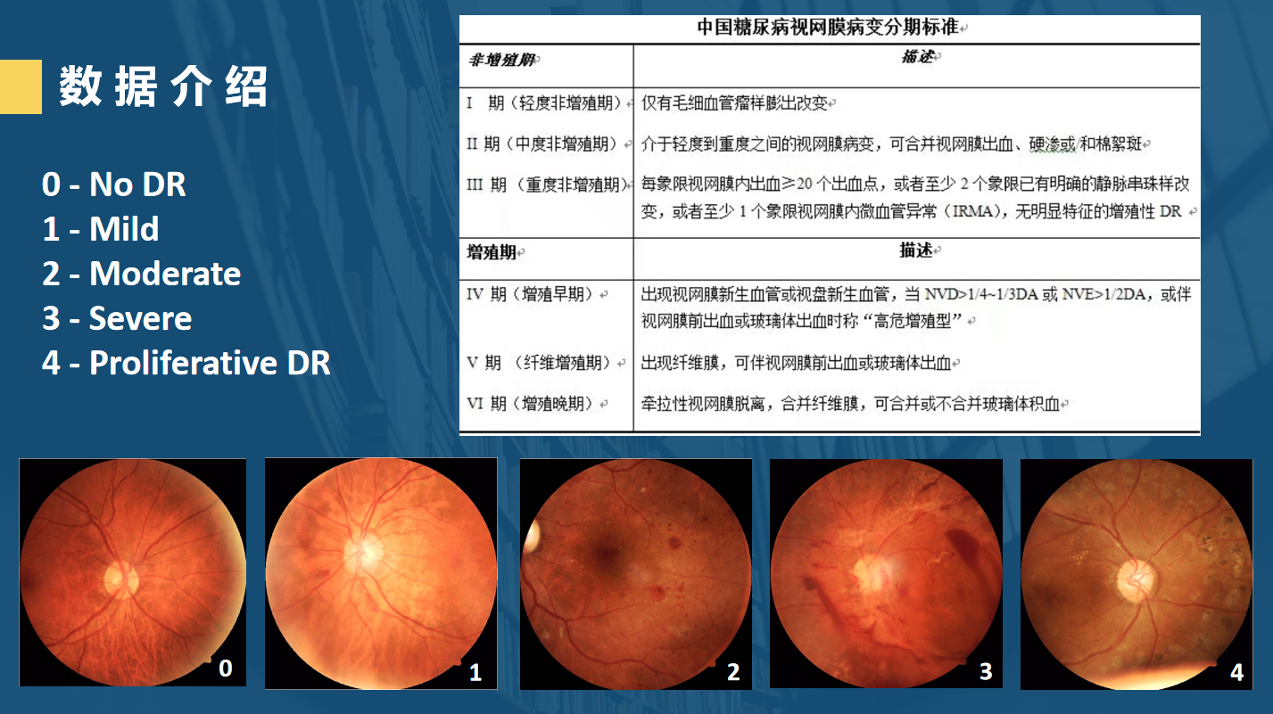 3 糖尿病视网膜病变分期