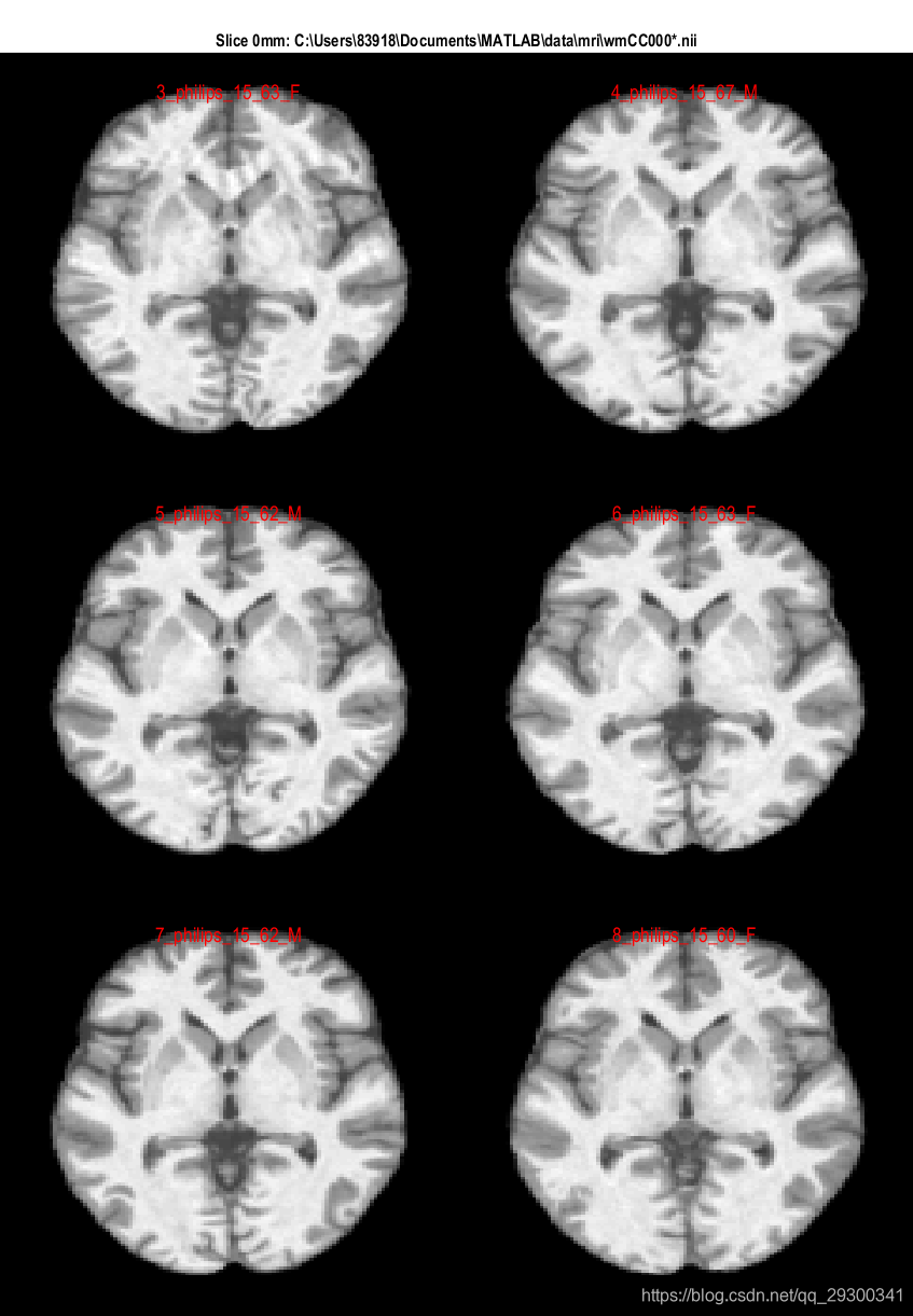 Bias, noise and intensity corrected T1 image