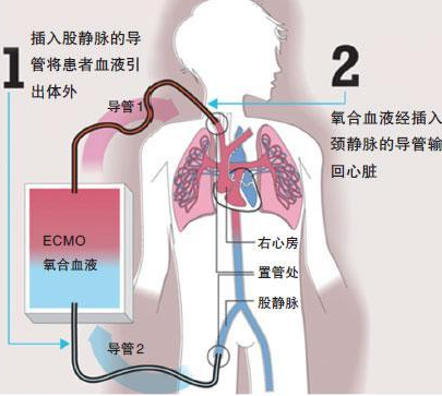 体外膜肺氧合（ECMO）