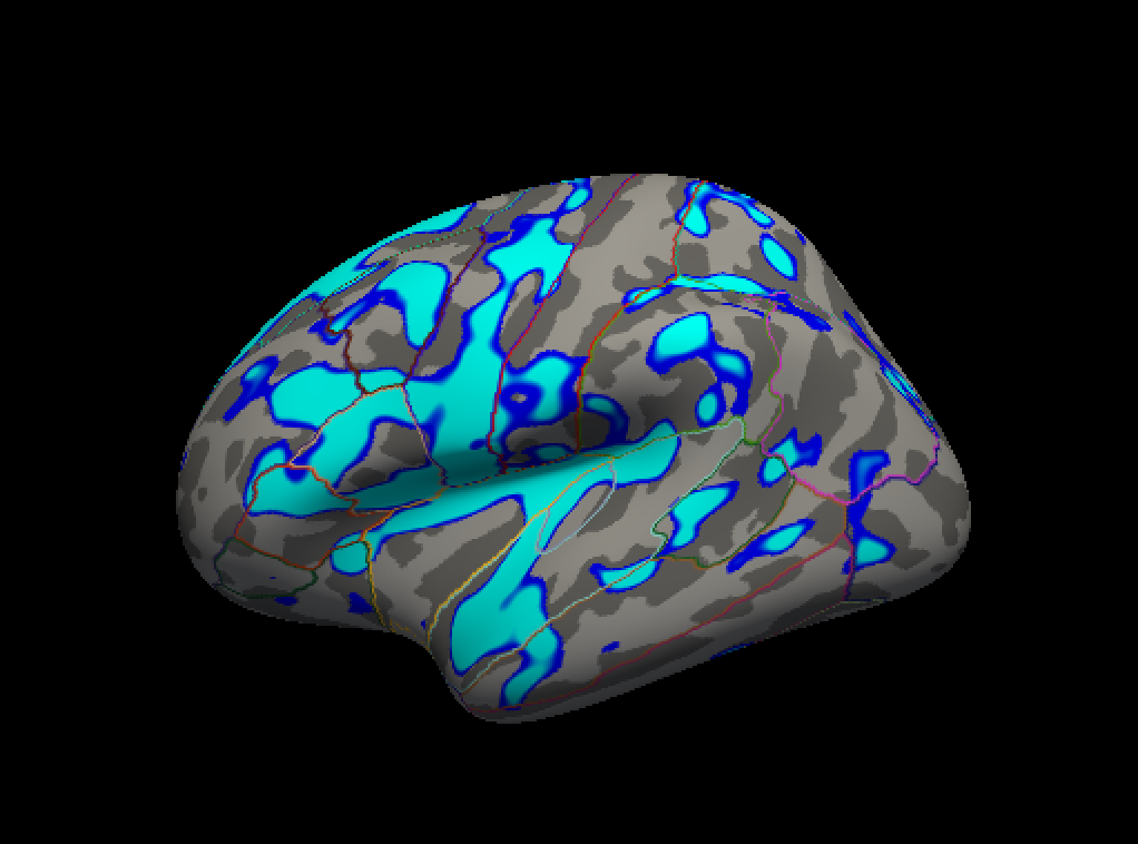 Freesurfer学习笔记——Surface Based Group Analysis 4/13_fsgd文件怎么创建-CSDN博客
