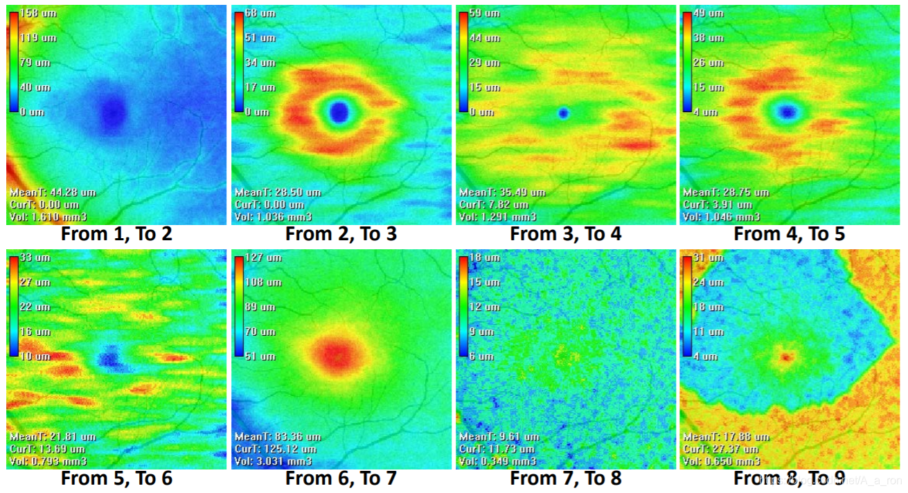 视网膜厚度分析示例