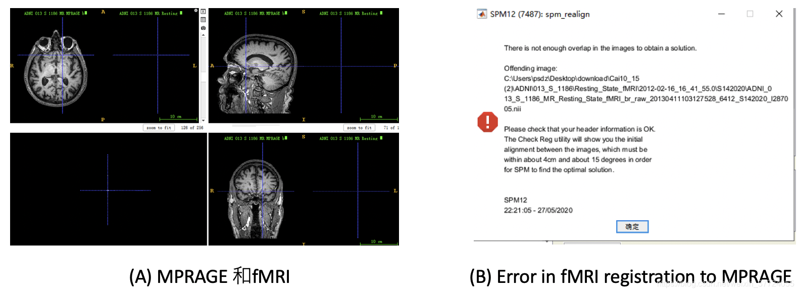 图1，直接从ADNI上面下载nii格式的数据所遇到的困境，MPRAGE与fMRI数据空间上相差太远，无法做registration。