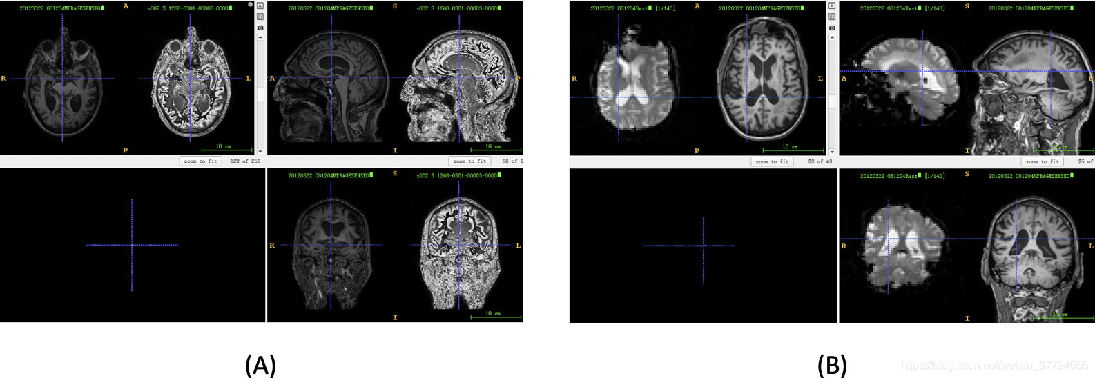 图3， A：Mricron dcm2nii和SPM dcm2nii处理结果对比；B：Mricron dcm2nii 处理MPRAGE和fMRI 结果