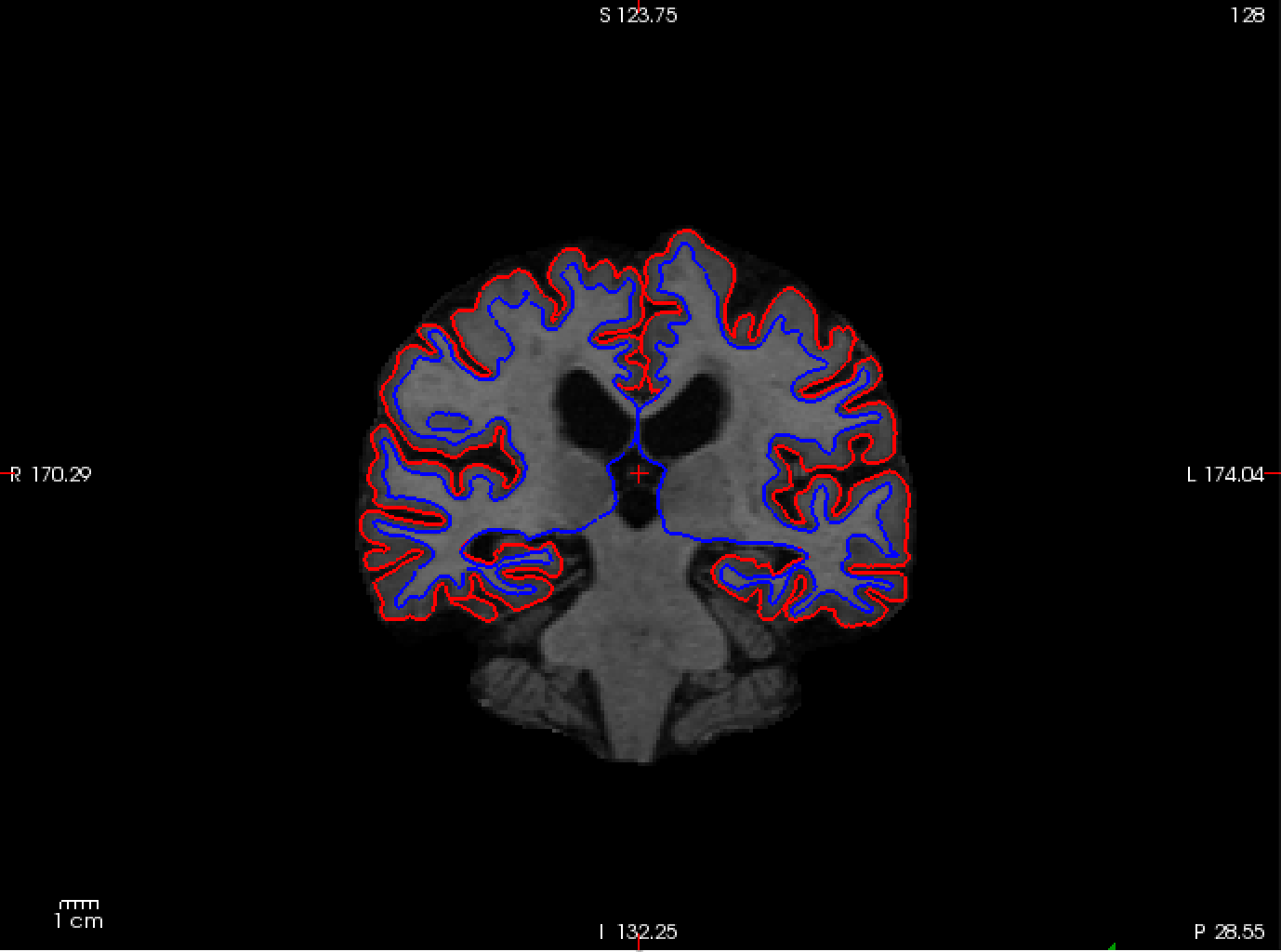 Freesurfer学习笔记——Longitudinal Tutorial 9/13_freesurfer 纵向数据-CSDN博客