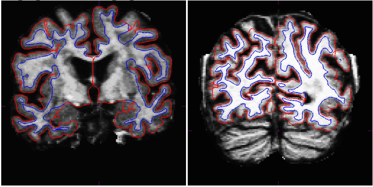 Freesurfer学习笔记——Longitudinal Tutorial 9/13_freesurfer 纵向数据-CSDN博客