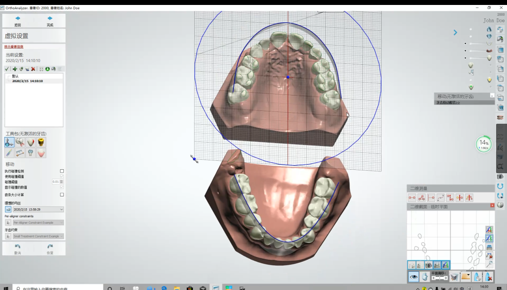 牙齒矯正模型軟件方案構思