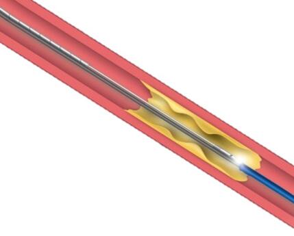 血流储备分数(FFR)