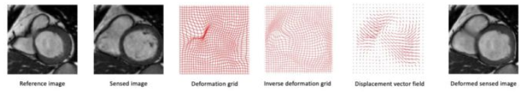 心臟MRI影像上的變形網格和位移向量場示例