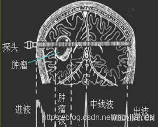 A型超声