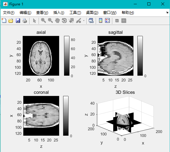在Matlab中可视化3D体积图像数据,例如MRI图像_volumetric image file-CSDN博客