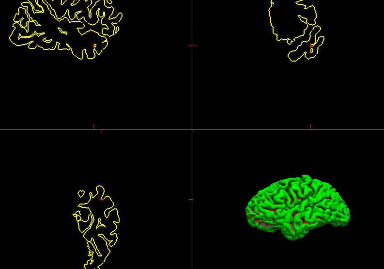【freesurfer学习1】freesurfer结构像批处理-CSDN博客