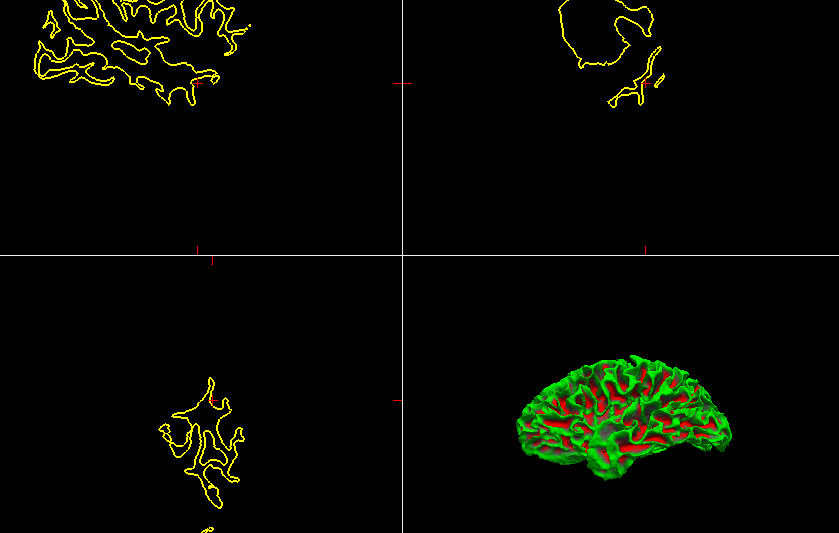 【freesurfer学习1】freesurfer结构像批处理-CSDN博客