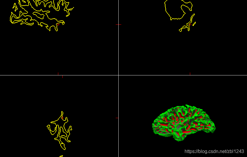 【freesurfer学习1】freesurfer结构像批处理-CSDN博客