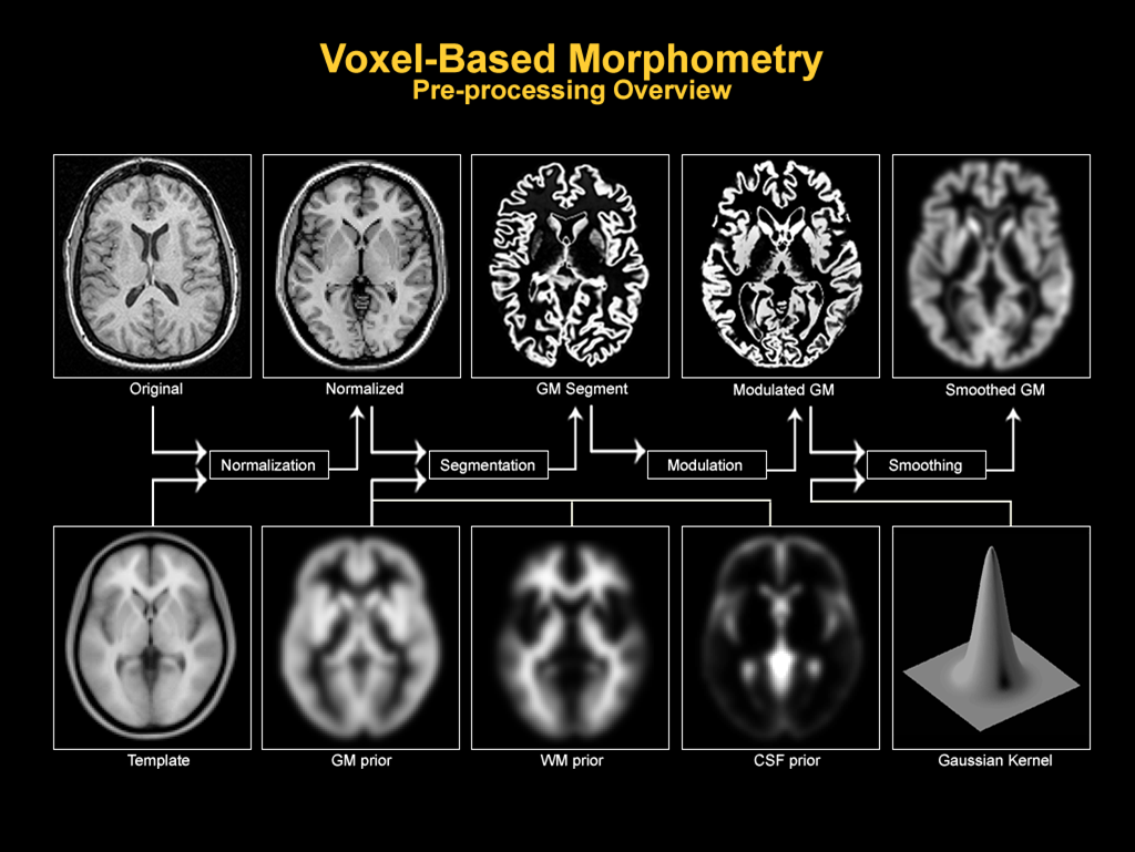 MRI脑影像分析从哲学到技术：一文搞懂VBM预处理基本原理（全网最详细解析）_意疏-开放原子开发者工作坊