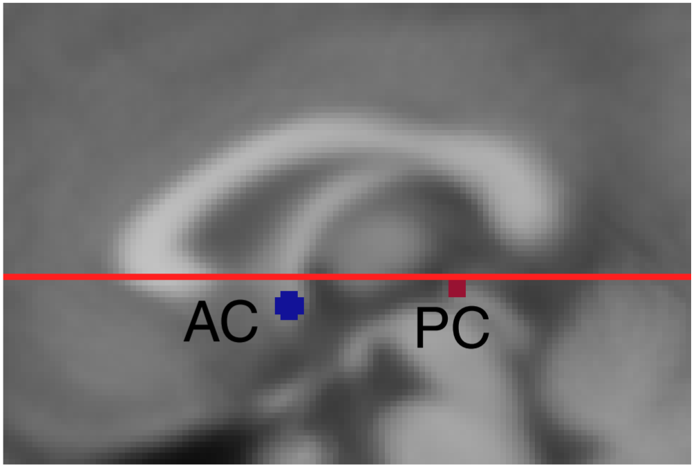 MNI152标准模板坐标空间与AC-PC line