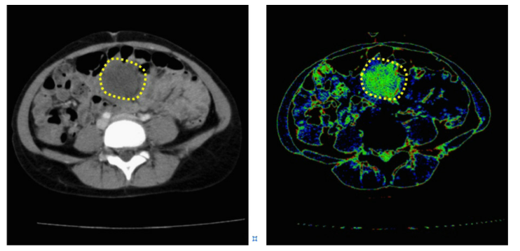 医学图像彩色化相关--20201208论文笔记Colorization of CT images to improve tissue ...