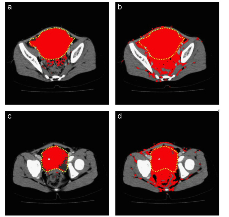 医学图像彩色化相关--20201208论文笔记Colorization of CT images to improve tissue ...