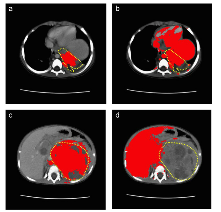 医学图像彩色化相关--20201208论文笔记Colorization of CT images to improve tissue ...