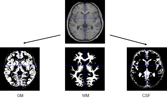 VBM脑组织分割结果