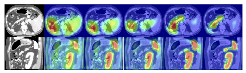 Attention U-Net:Learning Where to Look for the Pancreas