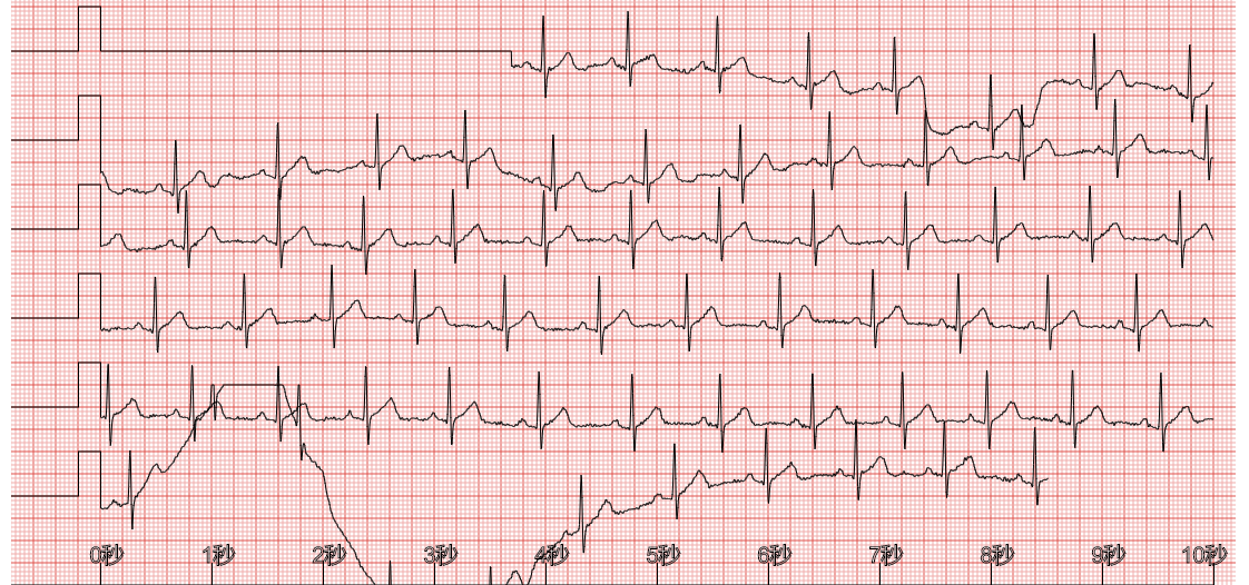快速中值滤波在心电图ecg中的应用