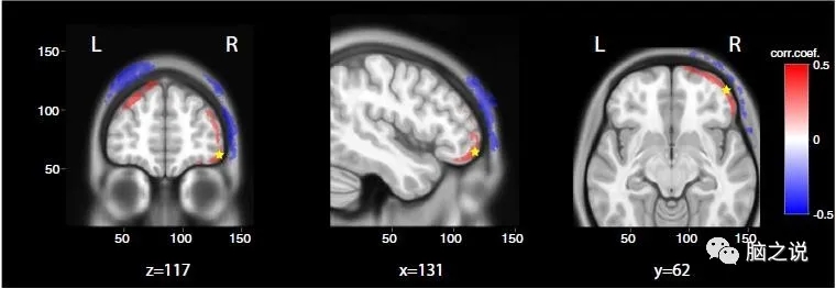 Scientific Reports：前额叶经颅直流电刺激对意识障碍患者干预作用的行为学和电生理证据