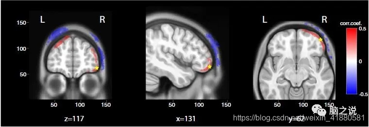 Scientific Reports：前额叶经颅直流电刺激对意识障碍患者干预作用的行为学和电生理证据