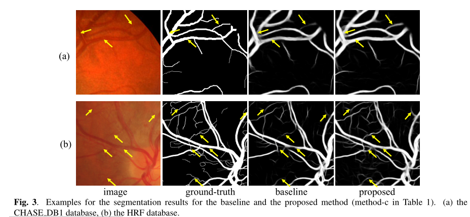 论文阅读——Retinal Vessel Segmentation via a Semantics and Multi-Scale ...