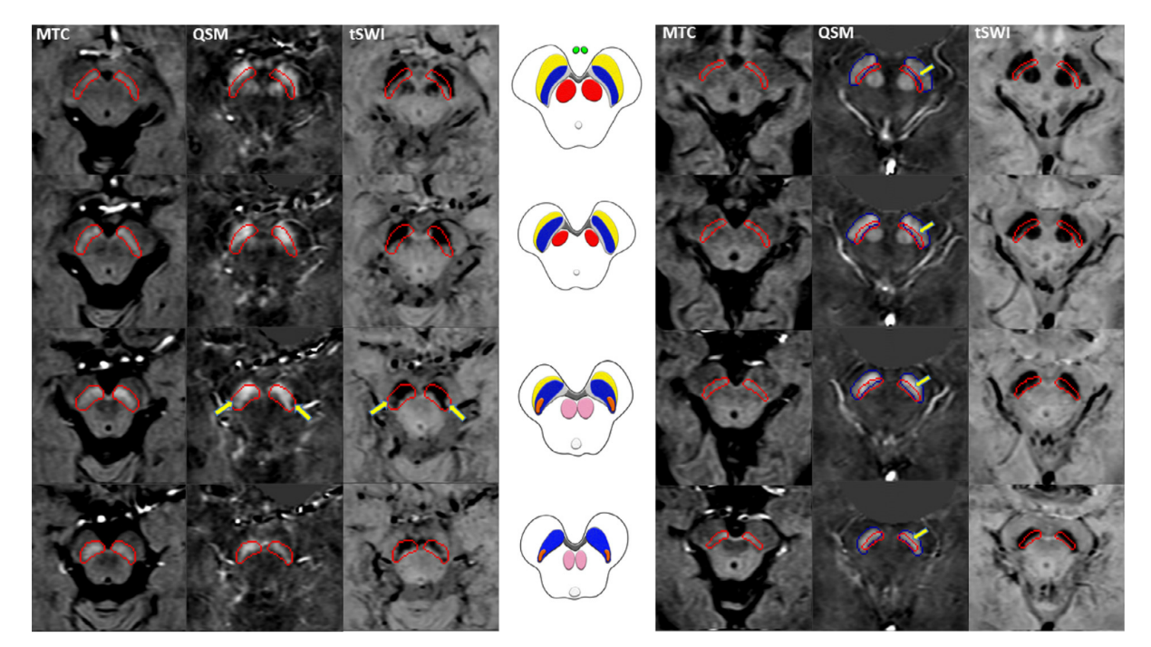 neuroimage磁共振3d梯度回波磁化转移序列同时对铁和神经黑色素进行