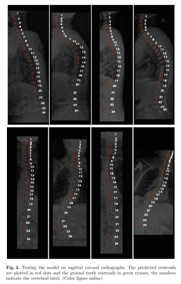 名患者的内部数据集,我们有冠状位和矢状位x线片,我们也有椎心的注释